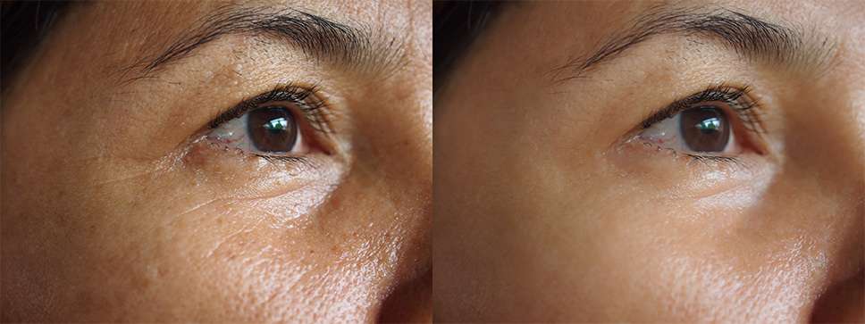 Image before and after treatment rejuvenation surgery on face asian woman concept.Closeup wrinkles dark spots pigmentation on senior female.