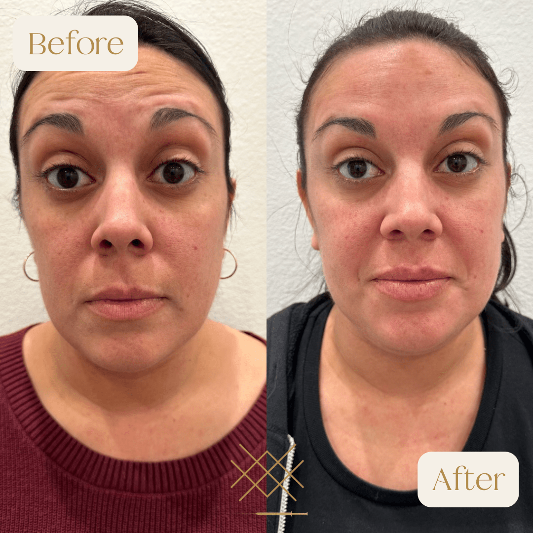 Botox Before and After Photo by Forever 30 Medical Spa in Prosper TX