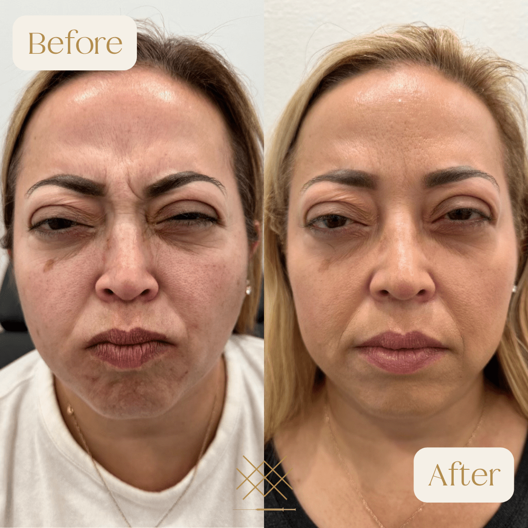 Botox Before and After Photo by Forever 30 Medical Spa in Prosper TX