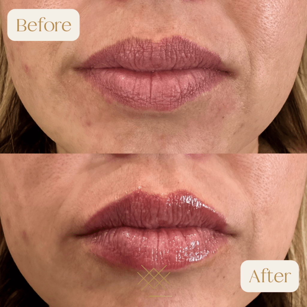 Lip Filler Before and After Photo by Forever 30 Medical Spa in Prosper TX