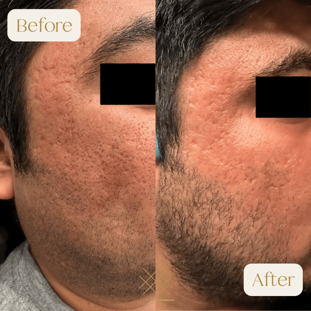 Morpheus8 Before and After Photo by Forever 30 Medical Spa in Prosper TX