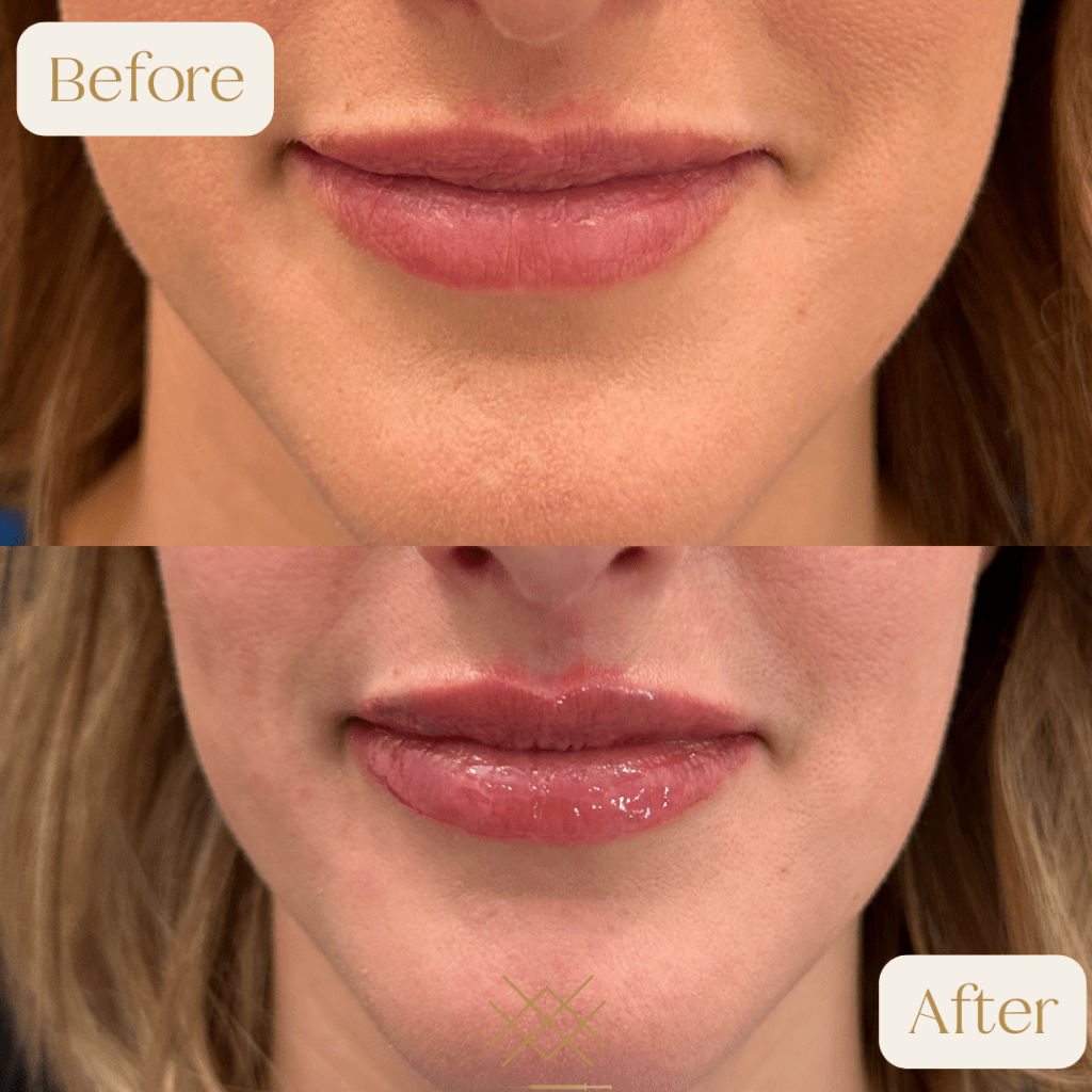 Lip FillerBefore and After Photo by Forever 30 Medical Spa in Prosper TX