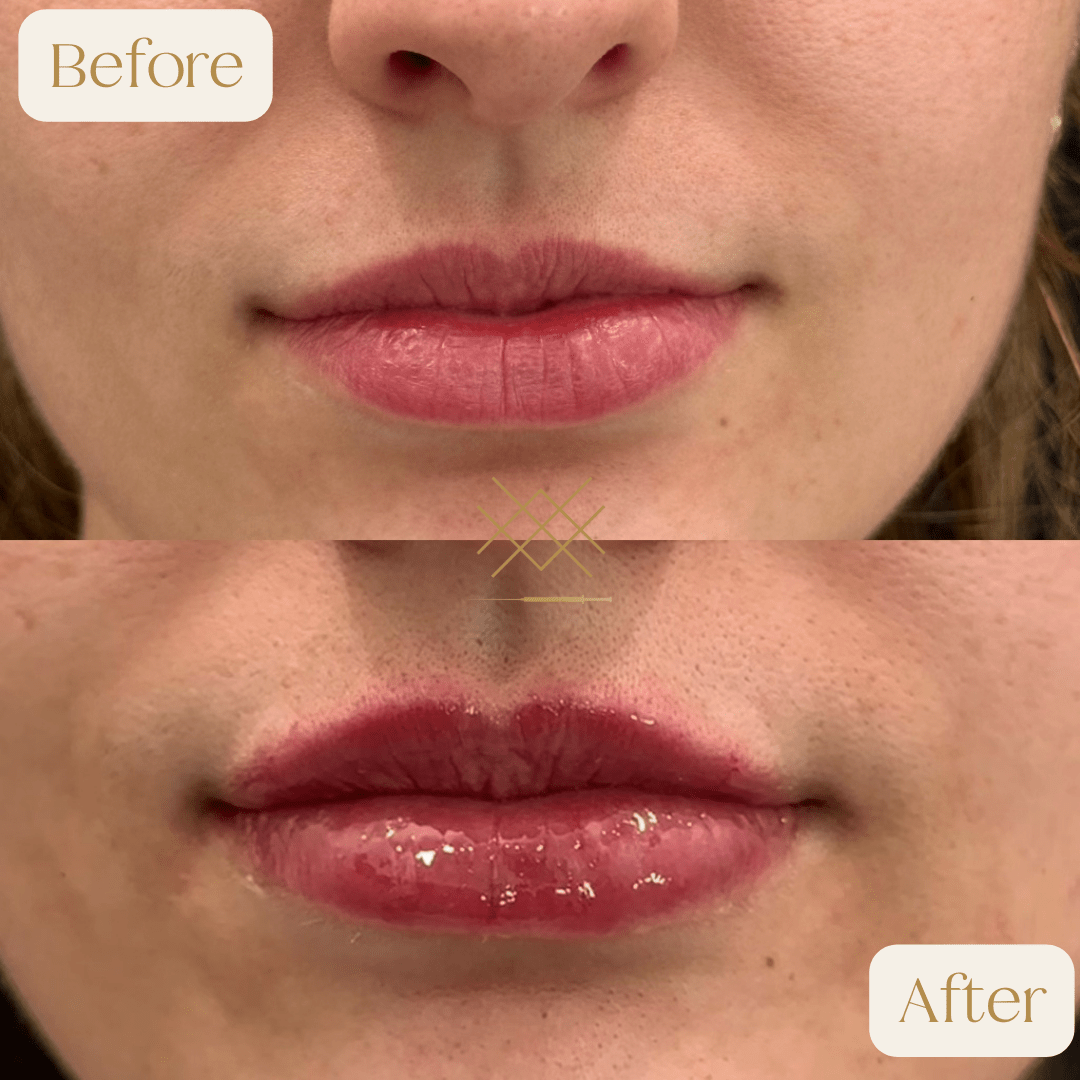 Lip Fillers Before and After Photo by Forever 30 Medical Spa in Prosper TX