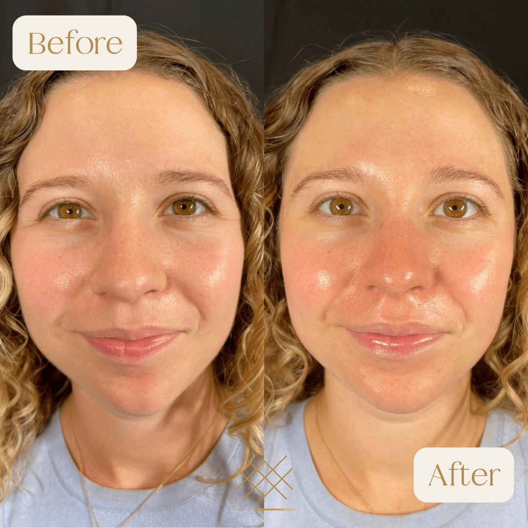 Hydrafacial Before and After Photo by Forever 30 Medical Spa in Prosper TX