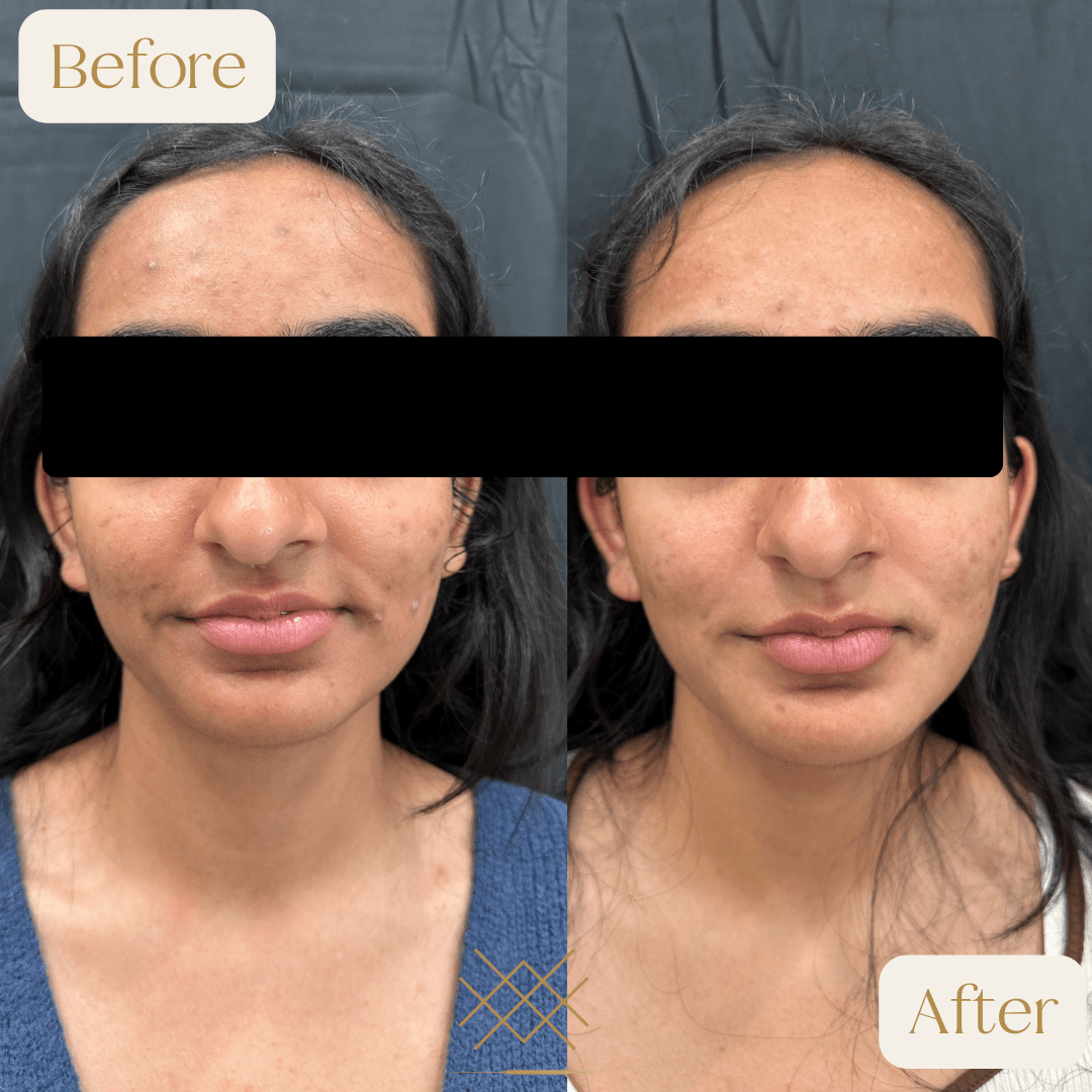 Chemical Peels Before and After Photo by Forever 30 Medical Spa in Prosper TX